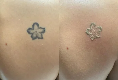 Safe Tattoo Removal: Saline vs. Laser Options in Melbourne