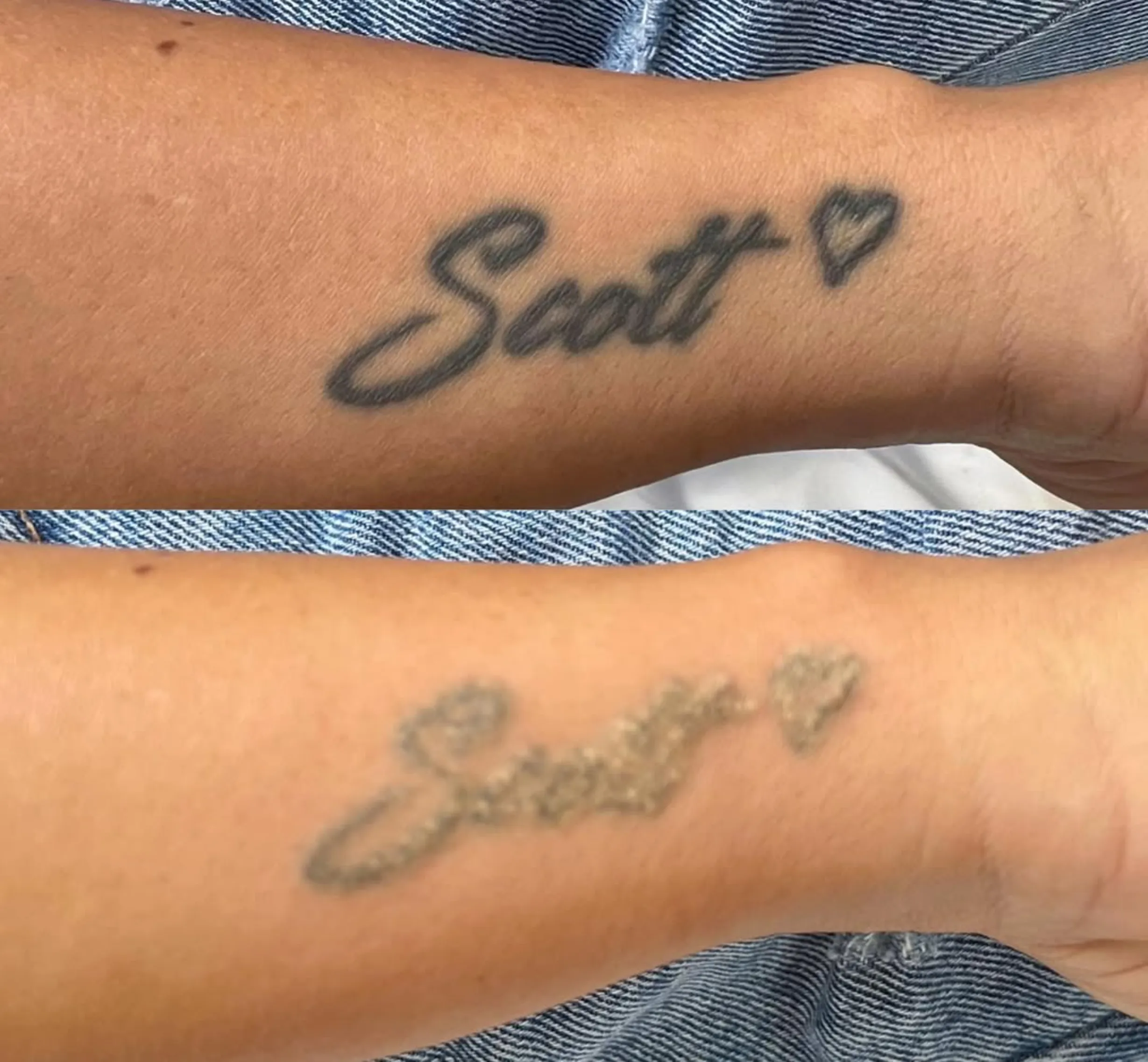 how much is tattoo laser removal