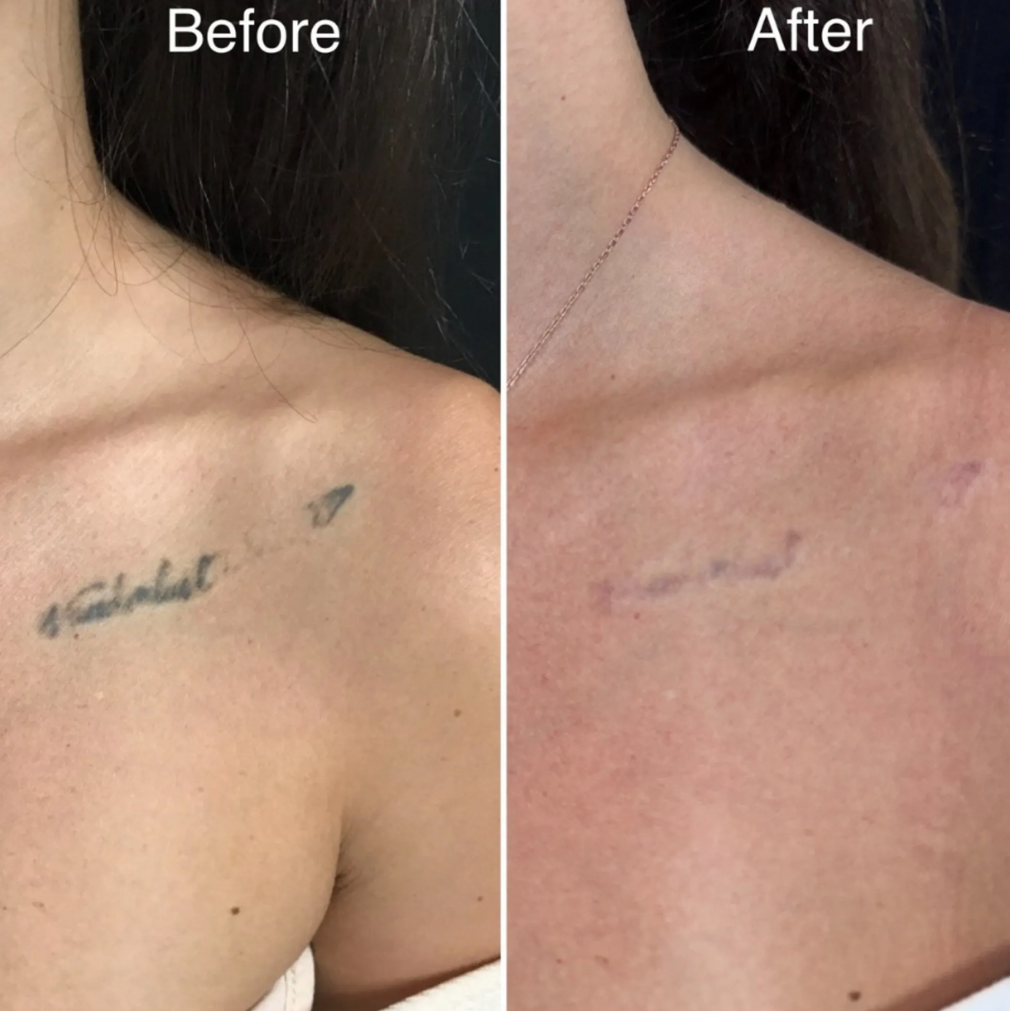 tattoo removal laser