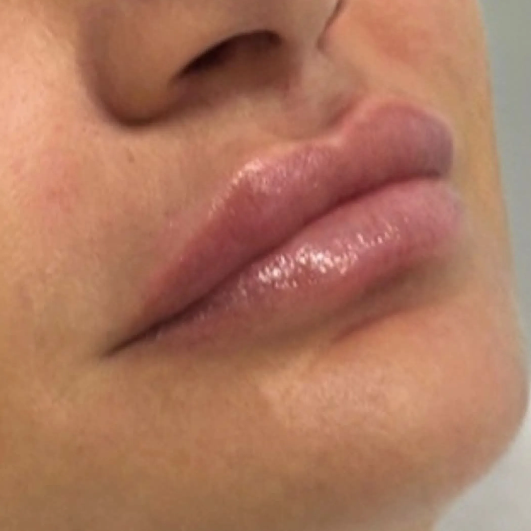 close-up of lips for cosmetic consultation