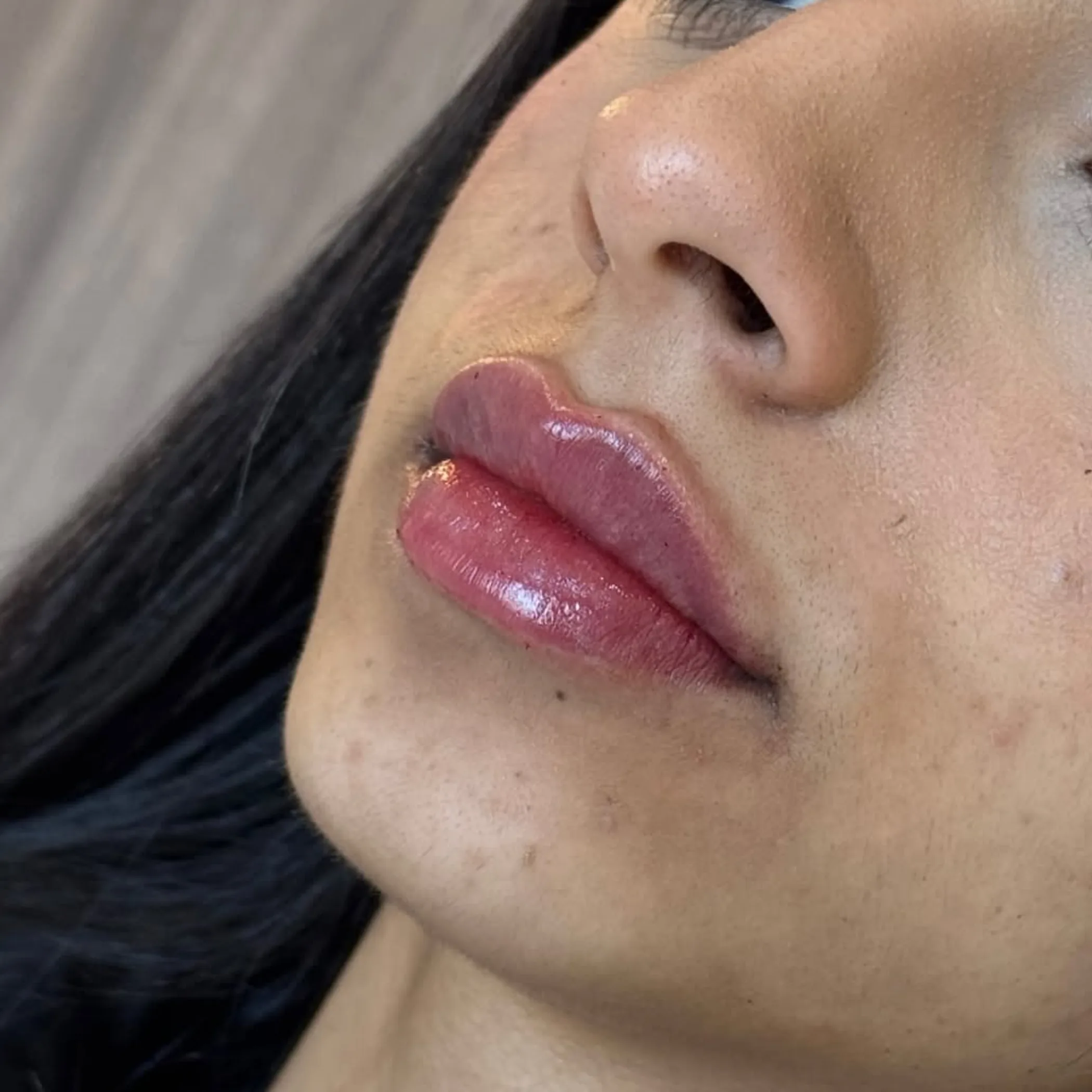 cosmetic lip injections close-up